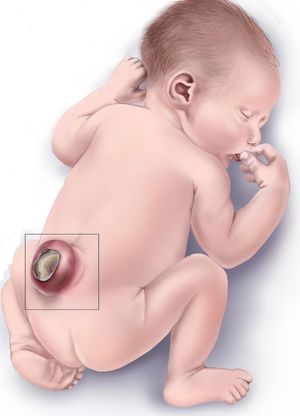 신생아에게 생긴 척추이분증 부위를 표현한 삽화. 미국 질병통제예방센터(CDC) 제공