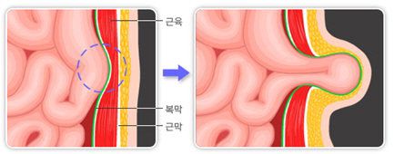 복벽의 약해진 근막·근육 부위로 내장이 밀려 나옴| 탈장의 발생 기전 자료 : 국가건강정보포털