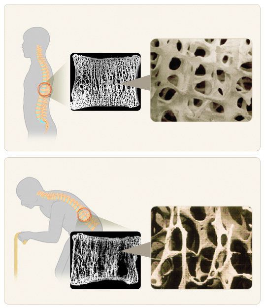 정상 상태의 뼈 조직(위)과 골다공증 환자의 뼈 조직(아래).  국가건강정보포털