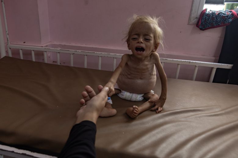 10일(현지시간) 가자지구 남부 칸유니스의 나세르병원에서 두 살 팔레스타인 아이가 어머니를 향해 손을 뻗고 있다. 샴은 간 비대, 심각한 영양실조, 복부 심각한 부종을 앓고 있으며 체중이 4㎏까지 줄었다. EPA연합뉴스