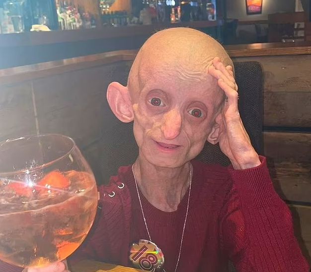 선천성 조로증을 앓다 18세 생일이 지난 후 결국 세상을 떠난 영국의 아샨티 스미스. 지난 5월 18세가 된 뒤 친구들과 칵테일바를 찾았을 당시의 모습