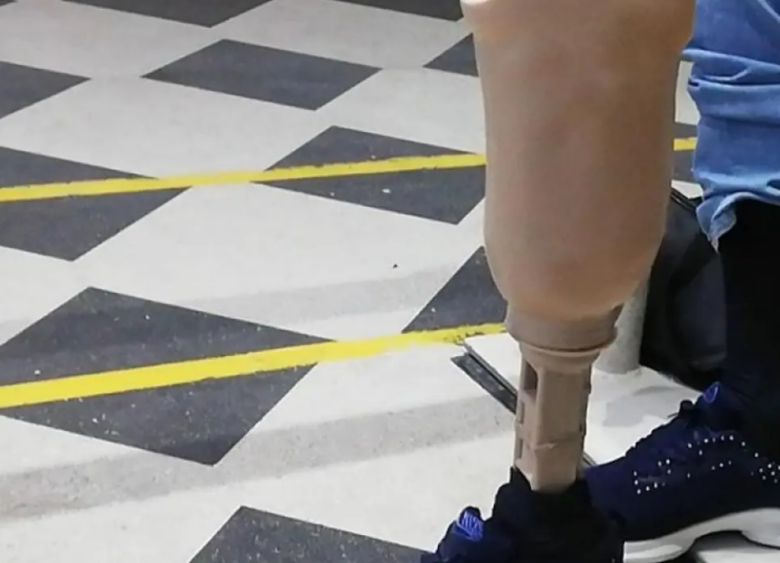 수개월 전 지뢰에 다리를 잃은 시리아 9세 소년