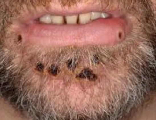 - 원숭이두창 확진자 자료 사진. 한국과학기자협회 제공