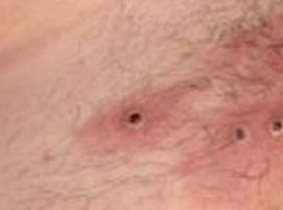 원숭이두창 확진자 증상 자료사진. 한국과학기자협회 제공.jpg