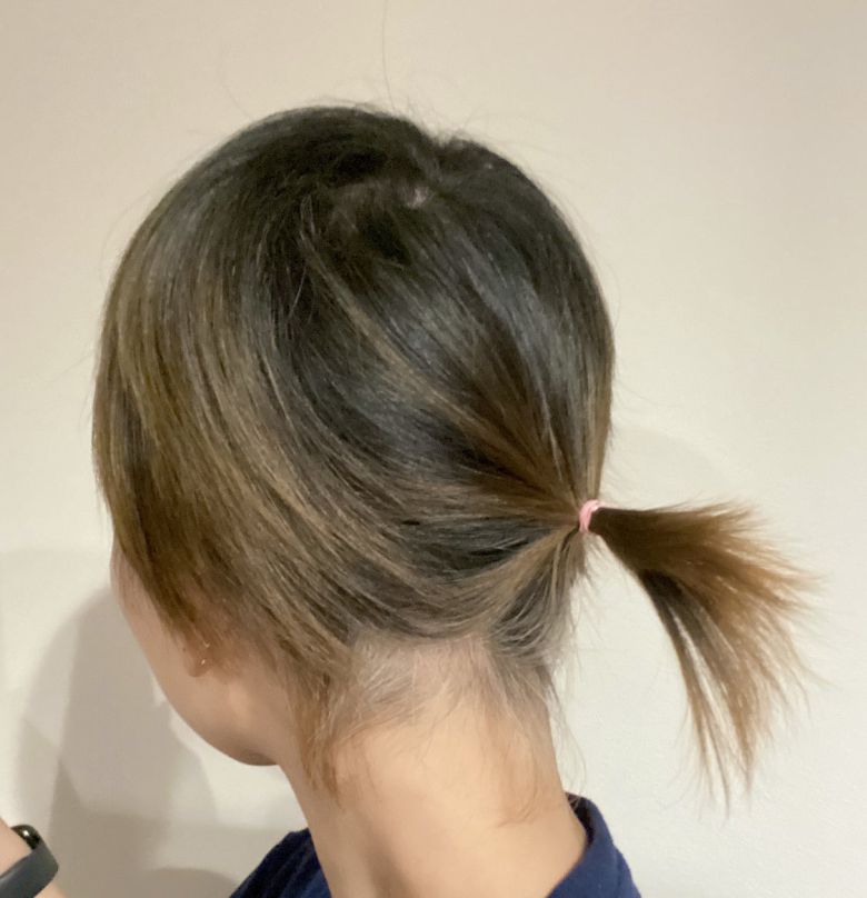 모더나 백신을 맞은 뒤 탈모 증상을 겪은 日여성 - 2021년 6월 코로나19 모더나 백신 1차 접종 후 탈모 증상을 겪었던 일본 여성 A씨. 1년여가 지나 10월 중순 공개한 A씨의 모발 상태. A씨 블로그 캡처