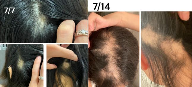 - 탈모증이 시작되고 A씨는 가발을 쓰고 출근했다. 블로그 캡처