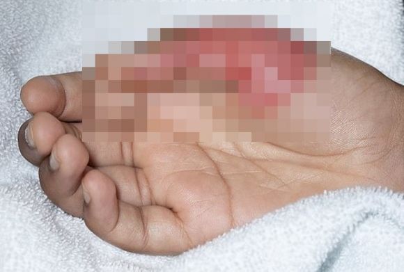 영국화상협회(BBA)는 “오징어게임 달고나 유행에 따라 어린이 화상 환자가 속출하고 있다”면서 대부분 수술이 필요할 정도로 부상이 심각한 상태라고 주의를 당부했다. BBA 제공