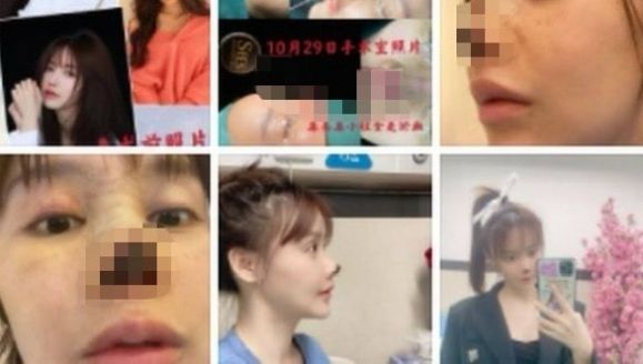 중국 여배우 가오류는 지난 2020년 코 성형수술을 받은 직후부터 심각한 부작용에 시달리고 있다. 가오류 웨이보