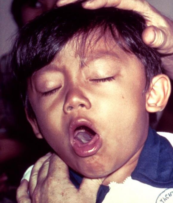 백일해 관련 이미지. 위키피디아