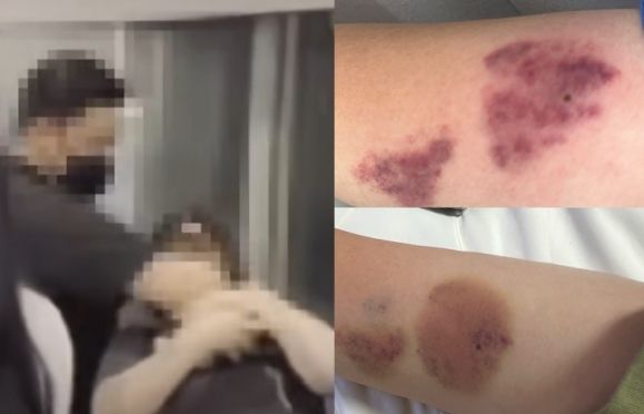 지난 8일 인천국제공항 탑승동으로 향하는 셔틀트레인 앞에서 걸그룹 ‘하츠투하츠’의 경호원이 한 20대 여성의 목덜미를 잡아 가로막고 있다.(왼쪽) 폭행을 당한 여성은 자신의 소셜미디어(SNS)에 피멍이 든 팔의 사진을 공개했다. 자료 : JTBC 사건반장·엑스(X)