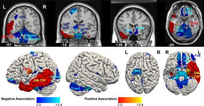 정신병질과 뇌 구조의 연관성을 나타낸 연구 첨부 자료. 출처=유럽 정신의학·임상신경과학 아카이브