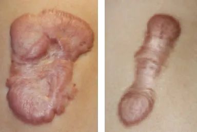 손상된 피부가 돌출되는 형태로 아문 켈로이드 흉터의 모습. 국가건강정보포털