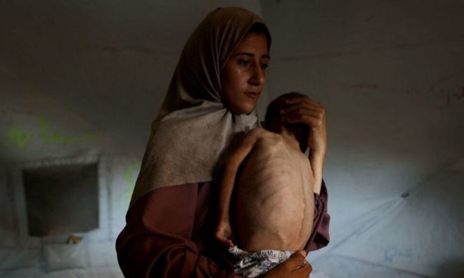 지난 24일(현지시각) 31살의 팔레스타인 여성 히다야가 가자북부 가자시티의 서쪽 샤티 난민 캠프 텐트 안에서 영양실조 증상을 보이는 18개월 된 아들을 안고 있다. AFP 연합뉴스