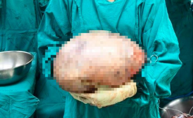 태국 의료진이 30대 여성 몸에서 제거한 난소 난종을 들고 있다. 페이스북 캡처