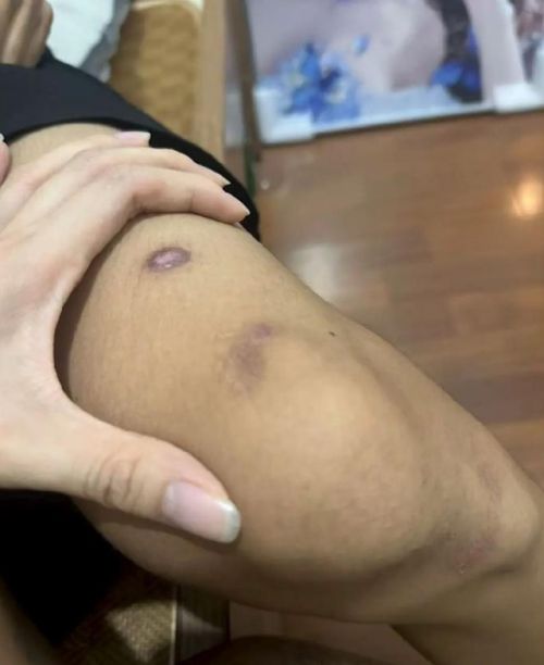 중국의 17세 여성이 2살 위 남자친구를 미얀마 범죄 조직에 팔아 넘긴 돈으로 해외 여행을 떠났다가 체포됐다. 범죄조직에서 극적으로 탈출한 19세 남성 피해자 몸에 남은 상처