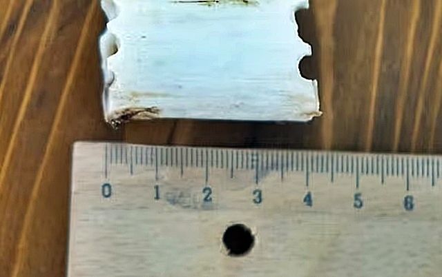 24일(현지시간) 데일리메일에 따르면 최근 튀르키예에서는 이른바 ‘키 축소 수술’이 새로운 의료 관광 상품으로 자리 잡고 있다. 키 축소술은 대퇴골이나 경골 일부를 제거하는 방식으로 진행된다. 다리뼈를 절단해 길이를 줄인 후, 잘린 뼈를 금속 막대로 연결해 고정시키고, 뼈가 완전히 치유되면 금속막대를 제거한다. 사진은 튀르키예 이스탄불의 ‘하이트 리덕션’ 자료.