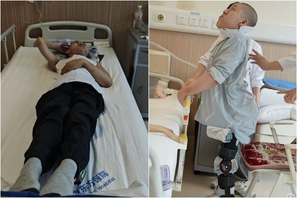 180도로 휘어진 척추로 인해 ‘폴더 소년(접힌 소년)’이라 불린 중국 청년이 대수술 끝에 몸을 곧게 펴는 데 성공했다. 의료진 제공·더우인 캡처