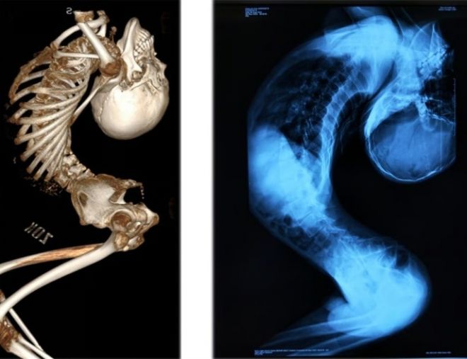 180도로 휘어진 척추로 인해 ‘폴더 소년(접힌 소년)’이라 불린 중국 청년이 대수술 끝에 몸을 곧게 펴는 데 성공했다. 의료진 제공
