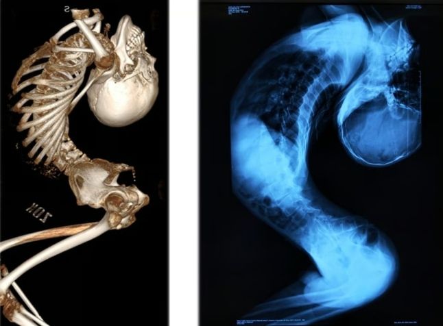 몸이 Z자로 접힌 ‘폴더 소년’ 장옌천(21)의 척추 모습