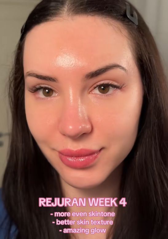 K뷰티가 전 세계적으로 인기를 끌고 있는 가운데, 최근 미용 시술을 받기 위해 한국에 오는 미국 여성들이 늘고 있는 것으로 알려졌다. 틱톡 캡처