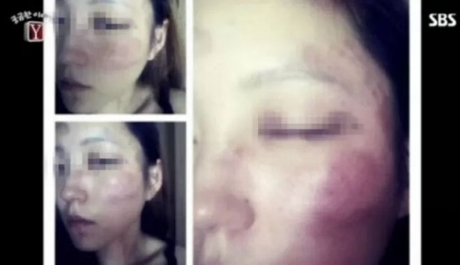 김 씨의 당시 폭행 당한 모습 (SBS 궁금한 이야기 Y 캡처)