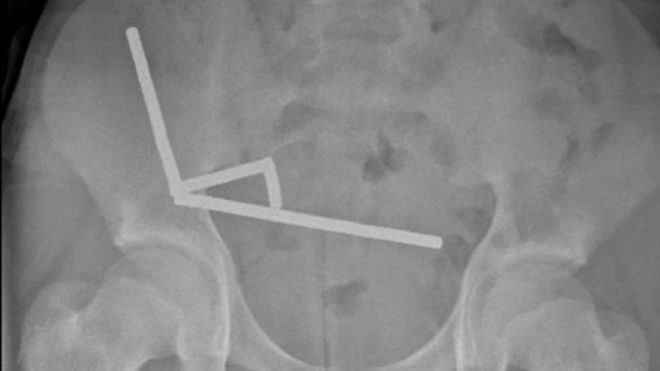 뉴질랜드에서 13세 소년이 네오디뮴 자석 200개 가까이를 삼켜 장 일부를 제거하는 수술을 받았다. 뉴질랜드 의학 저널