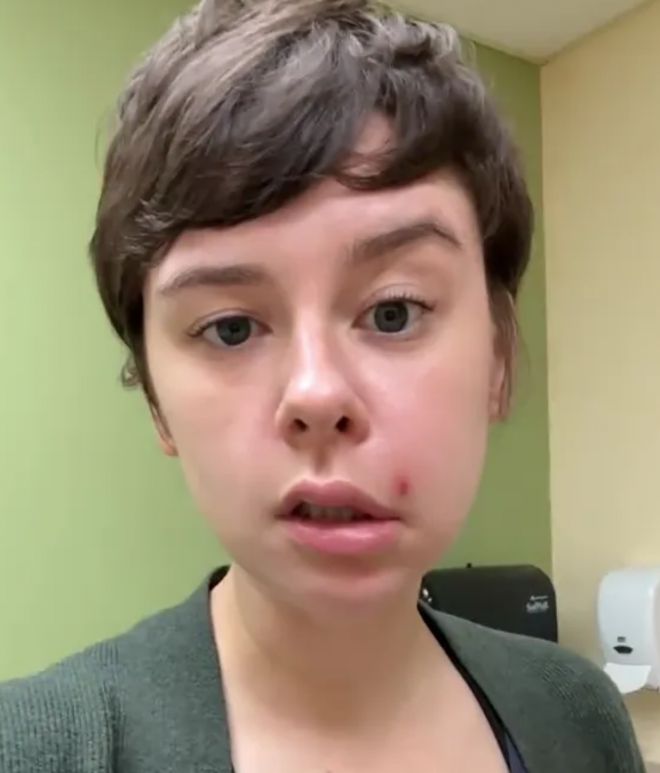 ‘죽음의 삼각형’으로 불리는 얼굴의 특정 부위에 난 여드름을 건드렸다가 심각한 감염에 걸릴 뻔한 한 여성의 사연이 알려지며 눈길을 끌고 있다. 틱톡