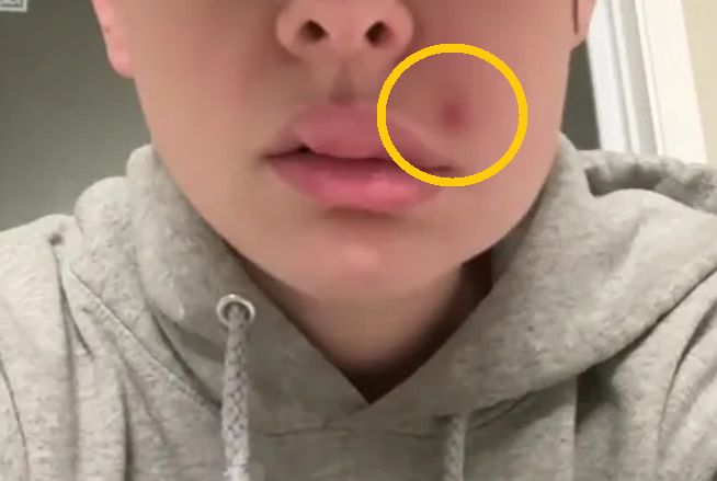 ‘죽음의 삼각형’으로 불리는 얼굴의 특정 부위에 난 여드름을 건드렸다가 심각한 감염에 걸릴 뻔한 한 여성의 사연이 알려지며 눈길을 끌고 있다. 틱톡