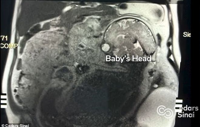 미국 캘리포니아에서 거대한 난소 종양 제거 수술을 앞두고 있던 한 여성이 임신 사실을 알게 된 뒤 며칠 만에 건강한 아기를 출산하는 기적이 일어났다. 사진=시더스-시나이 메디컬센터