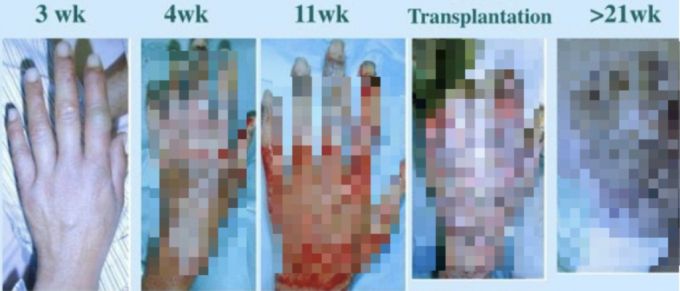 피폭이후 21주간 지켜본 작업자 오우치의 손. /사진=NHK 도카이무라 임계사고 취재반 '83일' 저서