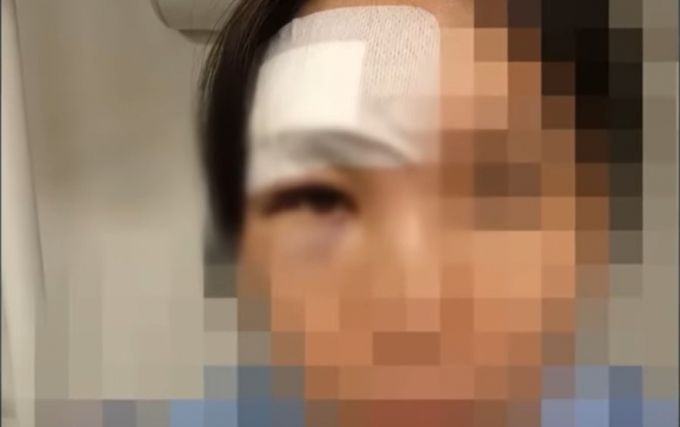 헬스장에서 지나가던 남성이 20kg짜리 바벨을 치는 바람에 뇌진탕 등으로 치료비 1000만원이 나왔다는 한 여성의 사연이 전해졌다. 보상을 약속했던 남성은 돌연 잠적했다./사진=JTBC '사건반장' 갈무리