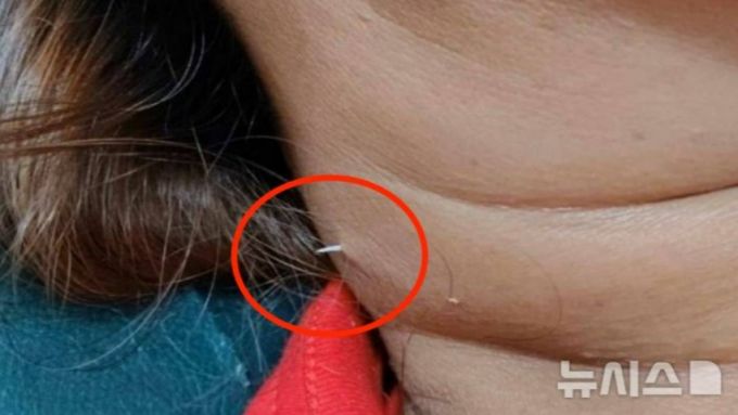 목에 걸린 생선 가시를 억지로 밀어 넣으려다가 부상을 입은 태국의 40대 여성 사연이 소개됐다. /사진=뉴시스(SNS 캡처)