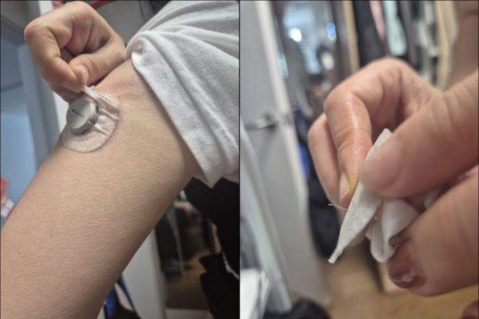 열흘 체험이 끝난 후 혈당 센서를 뜯어낸 모습. 저렇게 긴 바늘이 팔뚝에 박혀 있는 줄 몰랐다./사진=김소연 기자