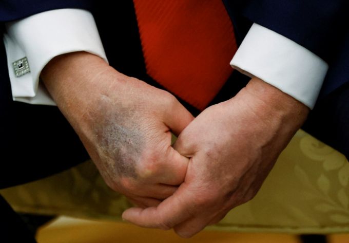 25일(현지시간) 미국 워싱턴DC 백악관 집무실에서 이재명 대통령과 회담하는 동안 도널드 트럼프 미국 대통령의 멍든 오른 손이 보인다. 2025.8.25  /로이터=뉴스1