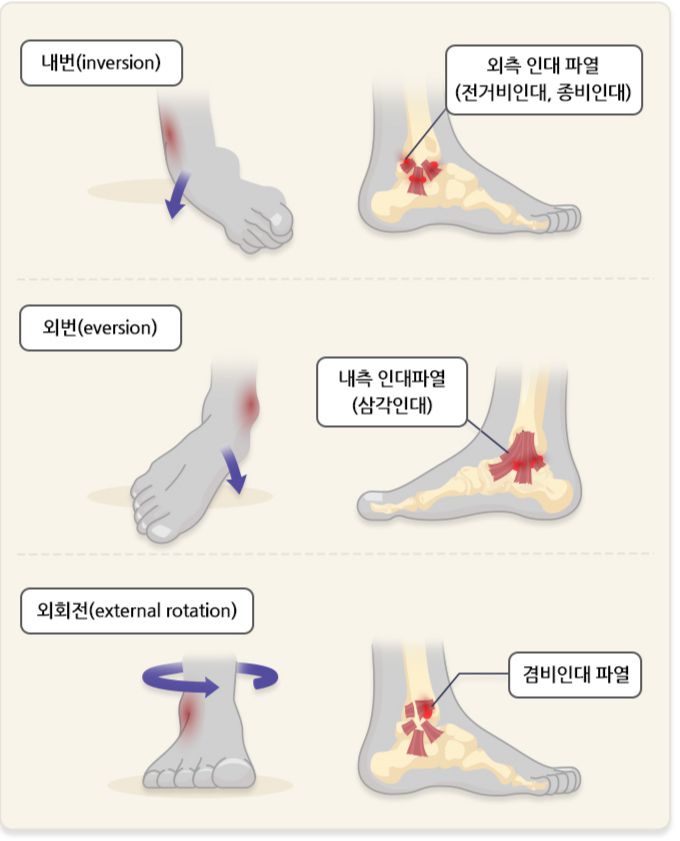 발목 인대를 다치는 방향. /자료=국가건강정보포털