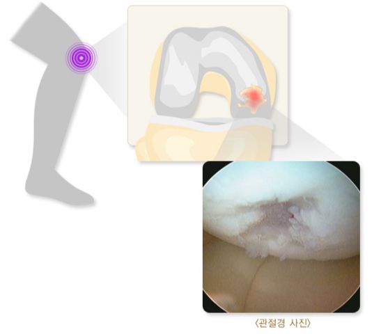 무릎의 관절 연골이 손상당한 모습. /자료=국가건강정보포털