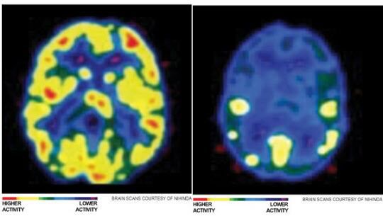 약물에 중독 되기 전의 뇌(왼쪽)와 약물 중독 후 뇌 모습. 약물 중독 후의 뇌는 활동능력이 현격히 저하된다. 반면 게임 중독은 약물 중독 만큼 생리적 변화가 규명되지 않았다는 지적이 나왔다./조선비즈