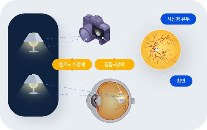 황반변성 개념(자료=와이투솔루션)