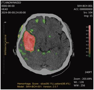 퍼플에이아이 뇌출혈 진단 보조 소프트웨어 '메디컬 인사이트 플러스 뇌출혈'(사진=퍼플에이아이)