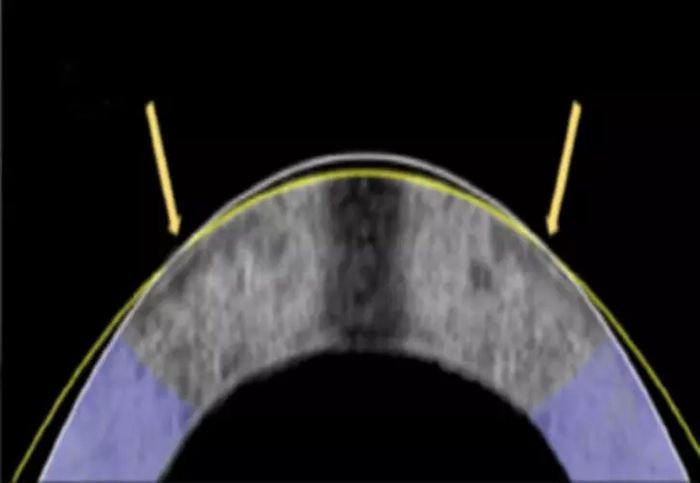 전기기계적 재성형으로 각막이 평평하게 변형됐다. 원래 각막(흰색 선)과 성형 후 각막(노란색 선). 사진=Daniel Kim and Mimi Chen