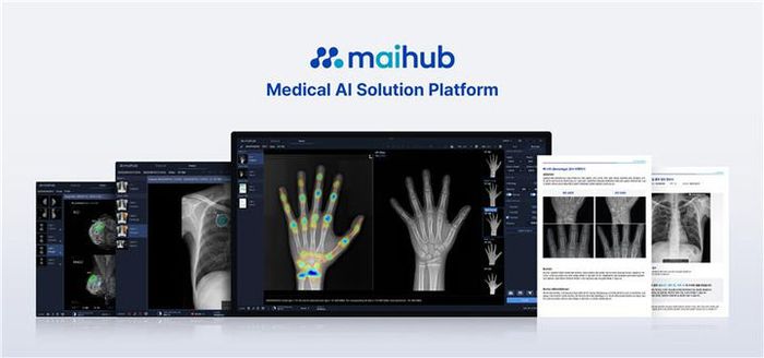 의료 인공지능(AI) 플랫폼 기업 마이허브가 인수한 골연령 분석 솔루션 '마이:본에이지'.(사진=마이허브)