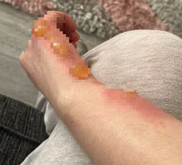 영국의 한 남성이 해당 식물을 만진 뒤, 손과 목에 발진이 생긴 채로 잠에서 깼다. 이후 그 발진은 '포도알 크기'의 물집으로 번졌다. [사진=데일리메일 캡처]