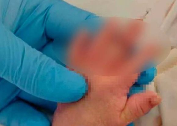 사진은 사고를 당한 아기 손. [사진=상관신문]