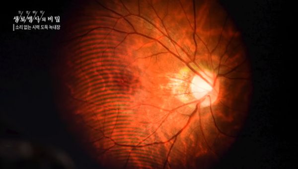 시신경 / 출처 - kbs 생로병사의 비밀 '소리 없는 시력 도둑 녹내장' 편 갈무리