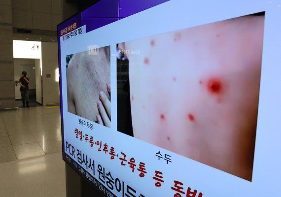 원숭이두창 관련 보도 /사진=뉴스1