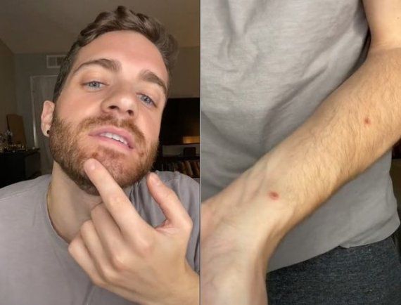 원숭이두창 감염 설명하는 미국 배우 맷 포드 /사진= 맷 포드 틱톡 캡쳐