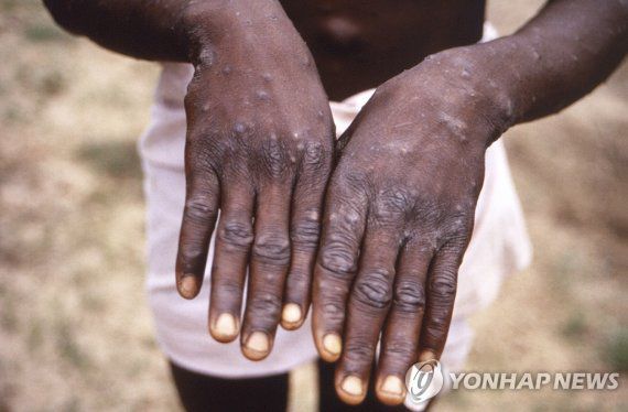 FILE - This 1997 image provided by the CDC during an investigation into an outbreak of monkeypox, which took place in the Democratic Republic of the Congo (DRC), formerly Zaire, and depicts the dorsal surfaces of the hands of a monkeypox case patient, who was displaying the appearance of the characteristic rash during its recuperative stage. The World Health Organization is convening its emergency committee on Thursday, July 21, 2022 to consider for the second time within weeks whether the expanding outbreak of monkeypox should be declared a global crisis. (CDC via AP, File) FILE PHOTO. AP PROVIDES ACCESS TO THIS PUBLICLY DISTRIBUTED HANDOUT PHOTO PROVIDED BY THE CDC; MANDATORY CREDIT