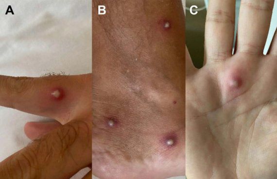 환자에게서 발견된 피부 발진 - BBC 갈무리 /사진=뉴스1