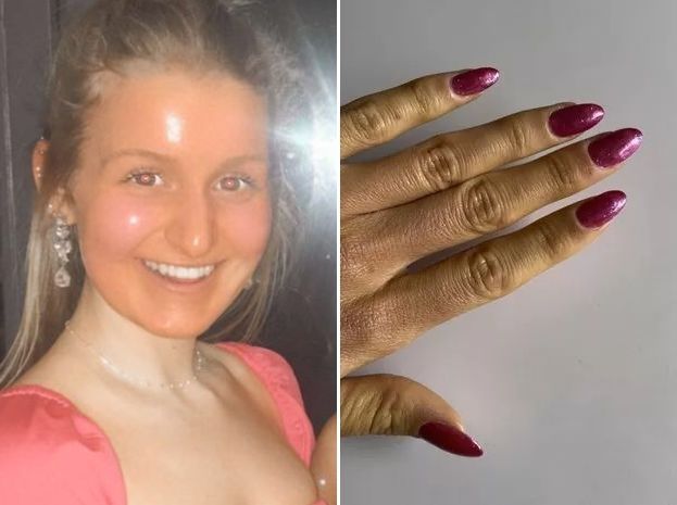 스코틀랜드에서 사는 20대 여성 데나 렌달. 그는 하루에 당근 10개씩 먹다가 얼굴이 노랗게 변하는 카로틴혈증을 겪었다. 사진=영국 데일리메일, 더미러