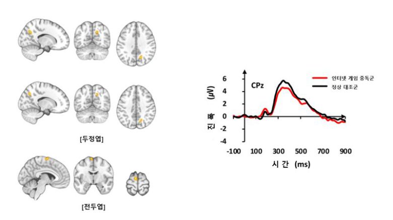 왼쪽 그림을 보면 기능적 MRI 검사 결과 인터넷 게임 중독군은 정상대조군들보다 두정엽과 전두엽 부위에서 뇌 활성이 증가한 것을 알 수 있으며, 오른쪽 그래프는 청각 자극에 대한 뇌파 신호의 진폭은 인터넷 게임 중독군이 정상대조군보다 감소한 것을 나타낸다. 삼성서울병원 제공